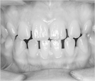 센텀 예치과에서는 앞니와 치아 사이의 벌어진 공간을 고려하여 벌어진 치아도 교정치료를 통해 가지런하게 만들어드리고 있습니다.