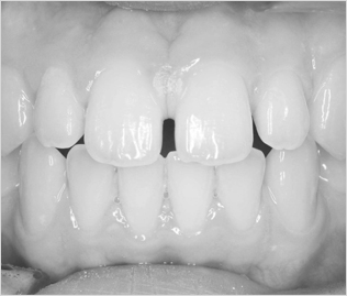 센텀 예치과에서는 앞니와 치아 사이의 벌어진 공간을 고려하여 벌어진 치아도 교정치료를 통해 가지런하게 만들어드리고 있습니다.