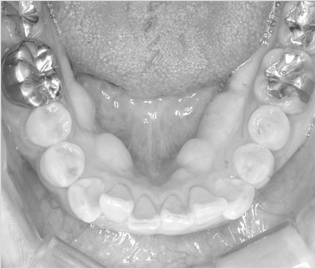 삐뚠 아랫니의 경우 치아의 안쪽 (설측)으로 교정 장치를 부착하여 가지런하게 배열하는 치료도 역시 해운대 예치과에서!