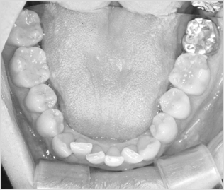삐뚠 아랫니의 경우 치아의 안쪽 (설측)으로 교정 장치를 부착하여 가지런하게 배열하는 치료도 역시 해운대 예치과에서!