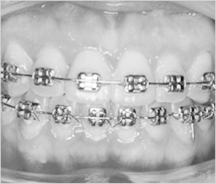 일반적인 금속장치이며 메탈교정이라고 불리기도 합니다. 심미성이 떨어지지만 비용이 상대적으로 저렴하고 관리가 편하다는 장점을 해운대 예치과에서 설명드리고 있습니다.