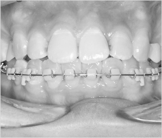 윗니는 치아 뒷편으로 장치를 부착하고 아랫니는 일반적인 방법으로 부착을 합니다. 센텀예치과에서 만나볼 수 있는 콤비장치는 설측과 순측의 합쳐진 교정입니다.