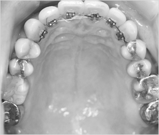 상하좌우로만 치아를 이동하여 가지런하게 하는 방법으로 앞니와 같은 부분 교정에 적합합니다. 2D교정장치는 해운대 예치과에서 만나보실 수 있습니다.