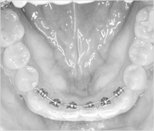 상하좌우로만 치아를 이동하여 가지런하게 하는 방법으로 앞니와 같은 부분 교정에 적합합니다. 2D교정장치는 해운대 예치과에서 만나보실 수 있습니다.
